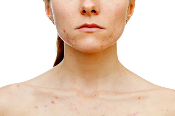 Masz blizny po trądziku? Powinnaś przeczytać te wskazówki ekspertów!