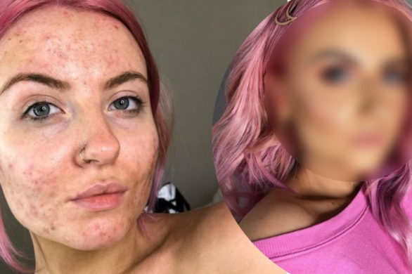 Blogerka pokazuje jak tuszuje trądzik. Jej sekretem jest TEN podkład!