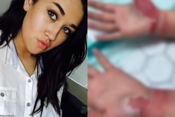 Nieudolna próba zrobienia paznokci zakończyła się poparzeniem trzeciego stopnia