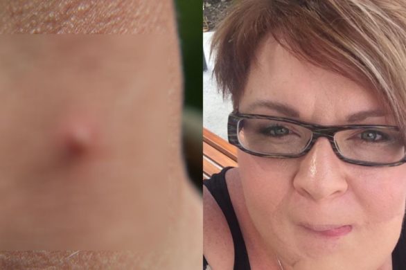 Kobieta usłyszała diagnozę. Niepozorny pryszcz na brodzie okazał się nowotworem