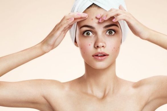 Drożdże na trądzik – jak stosować?