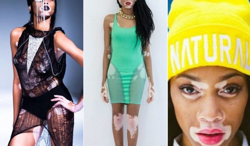 Winnie Harlow – modelka z bielactwem (FOTO)