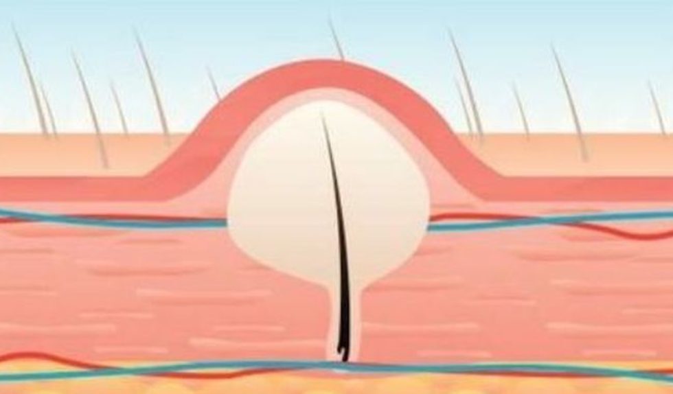 Tego rodzaju pryszcza nigdy nie powinnyście ignorować!