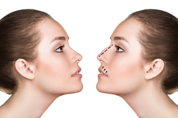 Czy warto zrobić sobie operację nosa?