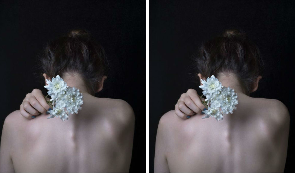 Trądzik na plecach – jak się go pozbyć?