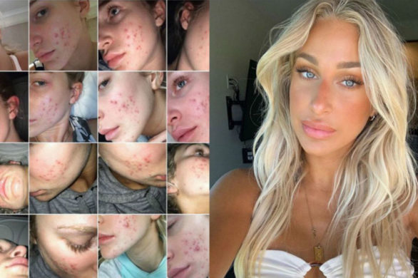 Wyleczyła trądzik tanim żelem do mycia. „Drogie kosmetyki to zbędny wydatek”