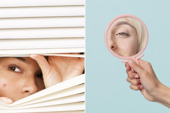 Czy można przedstawić trądzik bez stygmatyzacji? Ta kampania potwierdza, że to możliwe