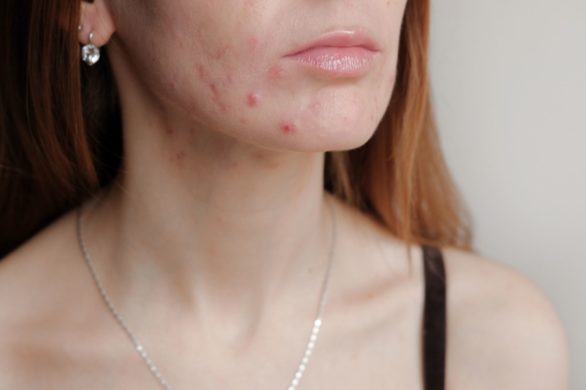 Jeśli masz tłustą lub problematyczną cerę, koniecznie wprowadź do pielęgnacji ten kosmetyk