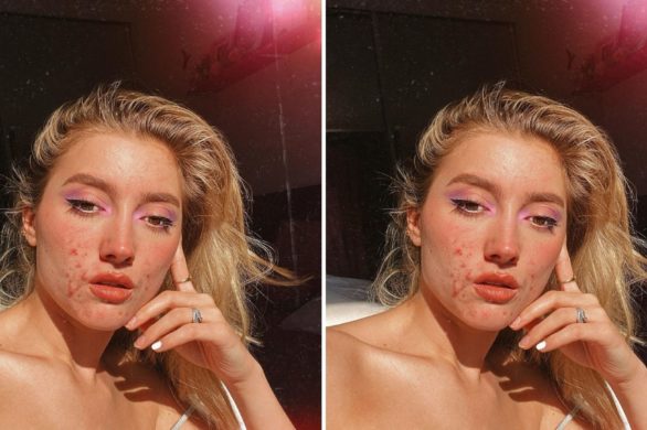 ASOS udostępnił zdjęcie modelki z trądzikiem. Kobiety dziękują za takie podejście do mody