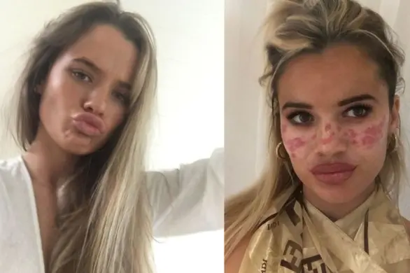 Wypróbowała modny trik urodowy z TikToka. „Wylądowałam w szpitalu z czasową utratą wzroku”