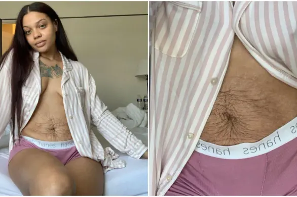 TikTokerka normalizuje temat rozstępów po ciąży