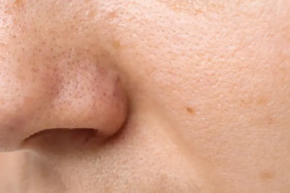 Czarne kropki wcale nie muszą być zaskórnikami