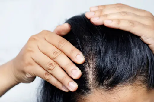 Naturalne składniki, które leczą łupież. Działają doskonale i dbają o zdrową skórę głowy