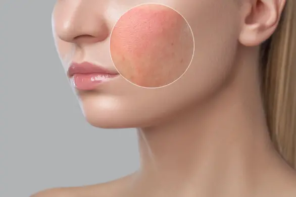 Zaczerwienienia na twarzy: jak się ich pozbyć i ujednolicić koloryt cery