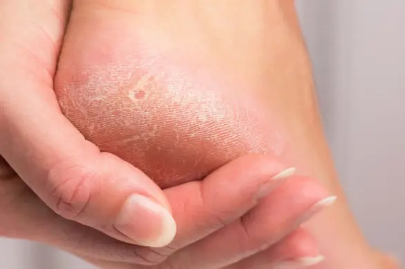 Zamocz pękające pięty w tym roztworze. Z tego genialnego przepisu korzystały kobiety w przeszłości