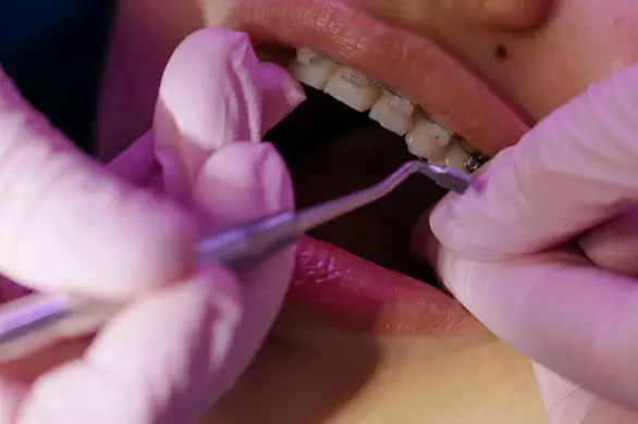 Trzy powody, by nie chodzić do dentysty, gdy masz opryszczkę