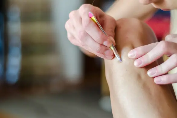 Jak pozbyć się wrastających włosów na nogach: skuteczne metody i pielęgnacja