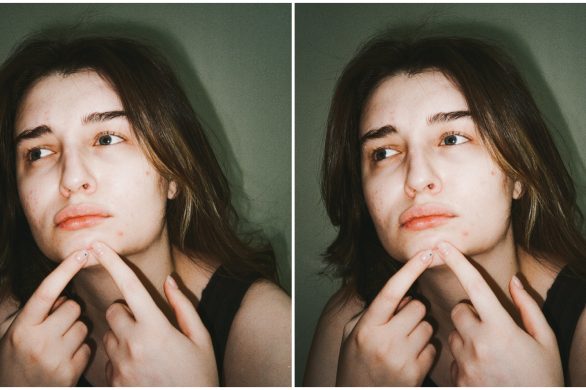 Dieta a trądzik. Tych produktów unikaj, mając problemy z cerą