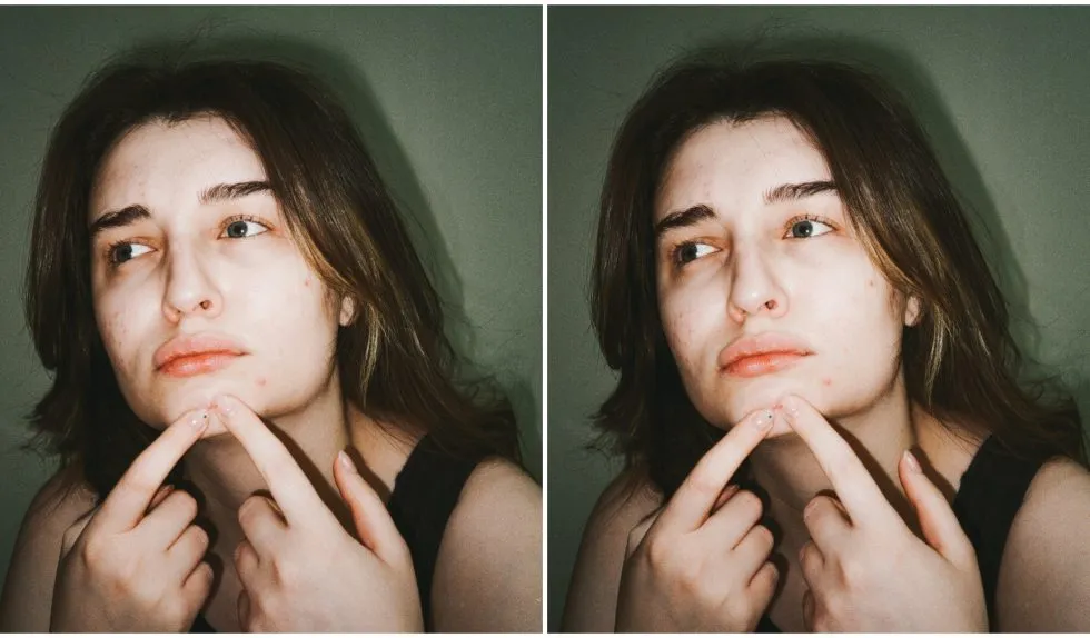 Dieta a trądzik. Tych produktów unikaj, mając problemy z cerą