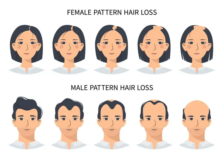 Hair loss stages, androgenetic alopecia male and female pattern