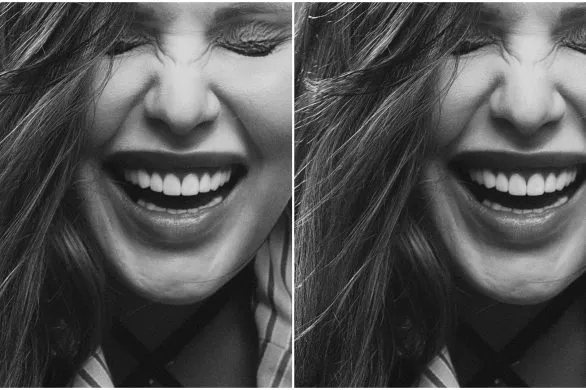 Bonding zębów. Wszystko, co warto o nim wiedzieć