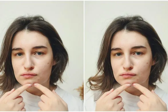 Gdy trądzik się nasila… Jakiej pielęgnacji potrzebuje twoja skóra?