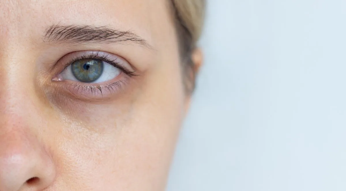 Cienie pod oczami- skąd się biorą i jak się ich pozbyć?