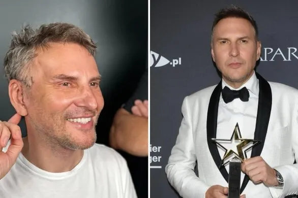 Krzysztof Gojdź pokazał efekty 7 dni po operacji za 150 tysięcy złotych. Tak wygląda po zdjęciu opatrunków